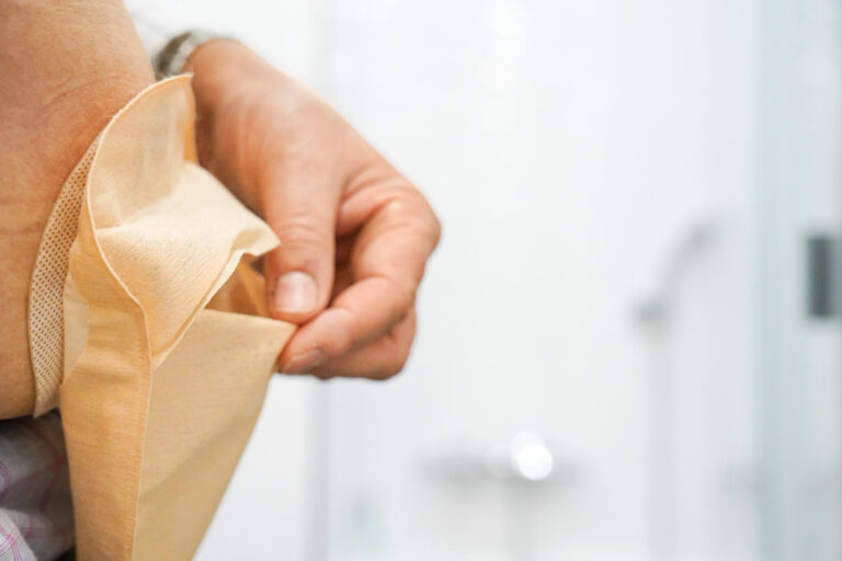 Living with an Ostomy: What Every Kenyan Patient Should Know