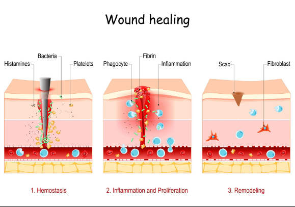 Managing Overgranulation in Wound Care
